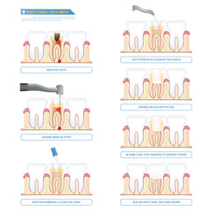 infographic root canal treatment, stages of root canal therapy