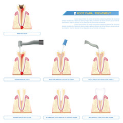 infographic root canal treatment, stages of root canal therapy..