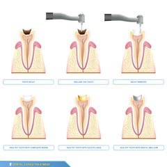 Infographics dental caries treatment and the different types of tooth fillings, composite resins, dental amalgam, gold fillings