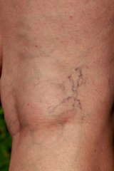 the phlebeurysm on legs