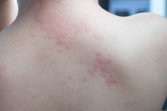 Close up image of  boy's body suffering severe urticaria, nettle