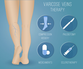 Infographics phlebology, treating varicose veins on women's legs. Slender female legs, spider veins.