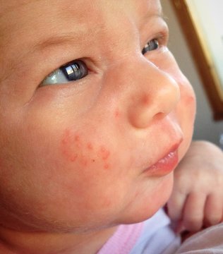 Neonatal Acne