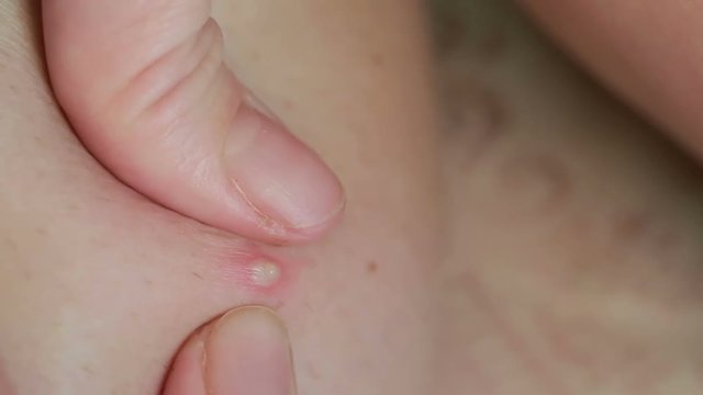 macro texture of burns on human skin back. wound treatment