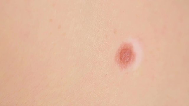 close up of mole on human skin. large birthmark