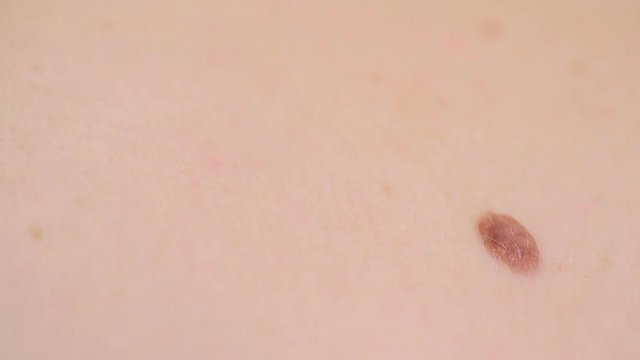 close up of mole on human skin. large birthmark
