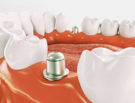 Dental implant - Series 1 of 3 - 3d rendering