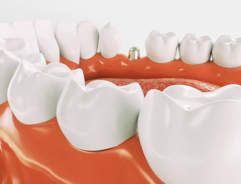 Dental implant - Series 3 of 3 - 3d rendering