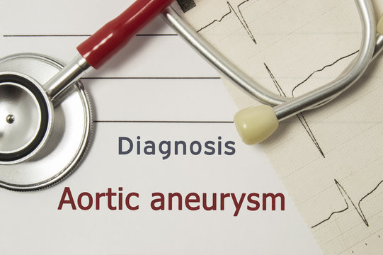 Cardiac diagnosis of Aortic aneurysm. On doctor workplace are red stethoscope, printed on paper ECG line and a pen close-up lying on medical handbook, which indicated diagnosis of Aortic aneurysm