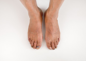  two feet with subungual hematoma