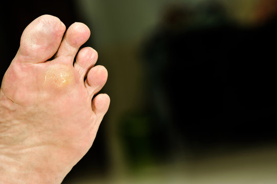 wart under foot can treatment by salicylic acid.