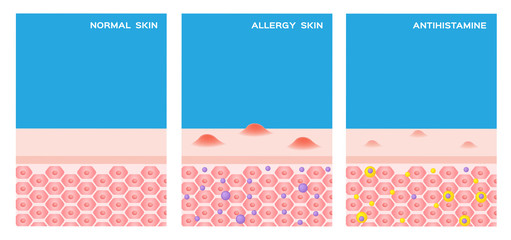 allergy skin vector . step of allergy skin before and after taking a medicine