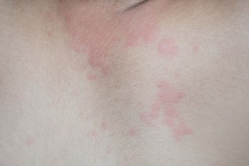 Fototapeta premium Close up image of boy's body suffering severe urticaria, nettle