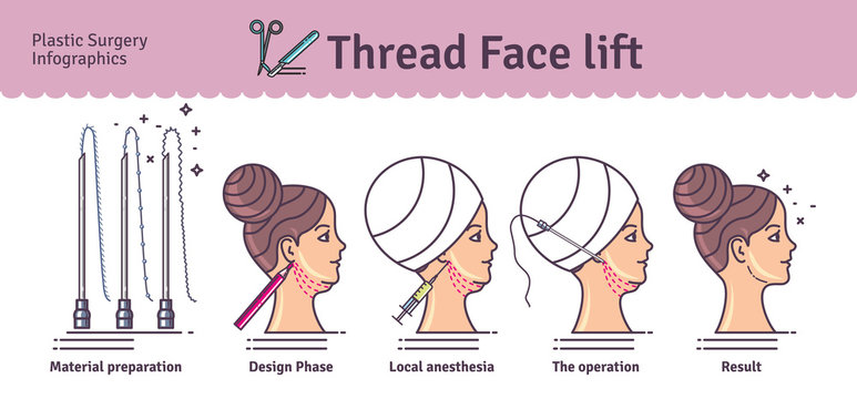 Vector Illustrated set with face lifting surgery by threads