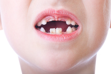 Children's mouth without teeth