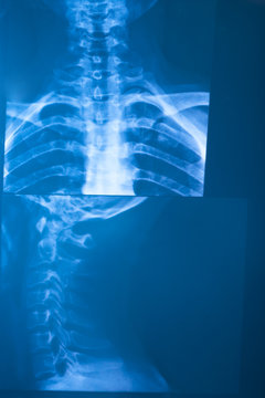 X-Ray Radiography

X-Ray film of back and side of the neck.
