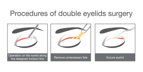 Procedures of double eyelids surgery. Illustration about cosmetic surgery. 