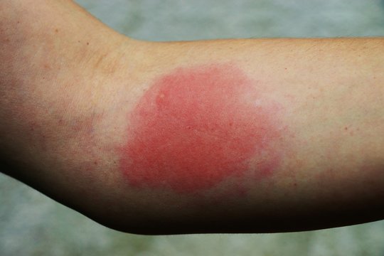 Painful allergic reaction to a wasp sting
