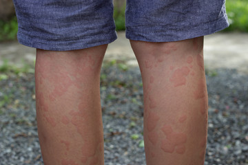 skin allergies, legs skin women.