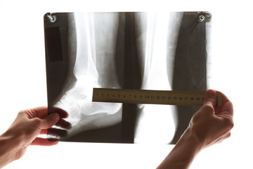 hand holding x-ray image feet on a white background