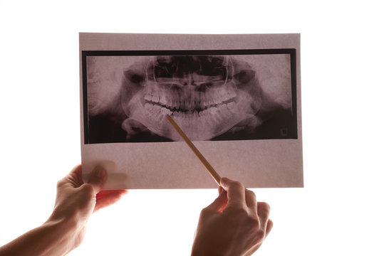 hand holding x-ray of the jaw and teeth