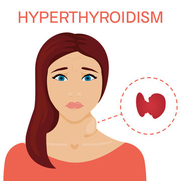 Woman with hyperthyroid gland. Hyperthyroidism symbol. Enlarged thyroid diagram sign. Patient with a goiter. Medical concept. Anatomy of people. Vector illustration.
