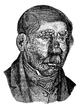 Leprosy or Hansen's Disease, vintage engraving