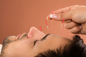 Man Receiving Acupuncture Treatment