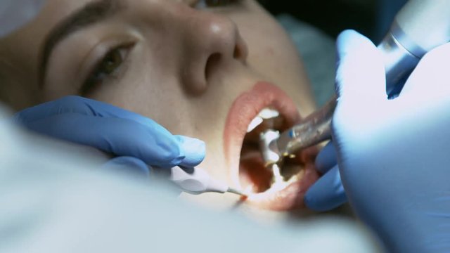 Medical dentist procedure of teeth polishing with cleaning from dental deposit and odontolith