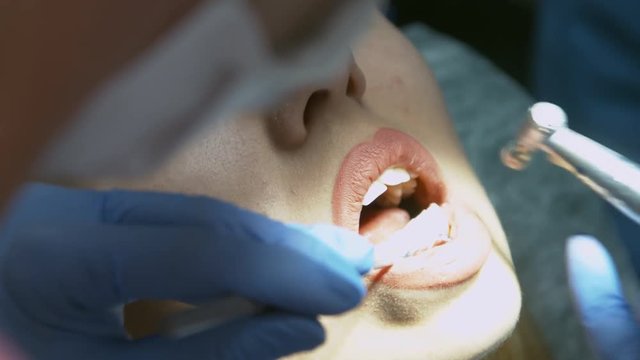 Medical dentist procedure of teeth polishing with cleaning from dental deposit and odontolith