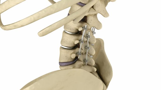 Spinal fixation system - titanium bracket. Medically accurate tooth 3D animation