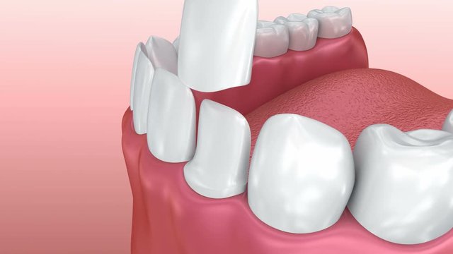 Dental Veneers: Porcelain Veneer installation Procedure. 3D animation