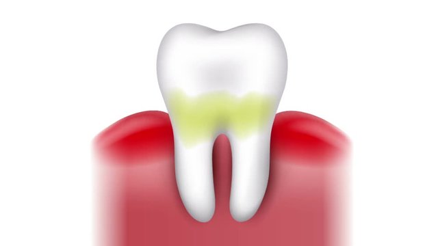 Tooth caries formation, dental plaque, loss of calcium, phosphate and finally caries and cavity