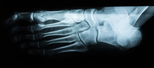 Fuß Röntgenaufnahme seitlich