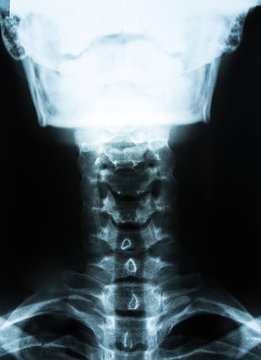 Halswirbelsäule HWS Röntgen Bild Aufnahme