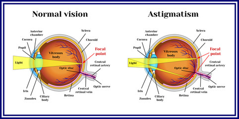 Refractive errors eyeball. Astigmatism. - obrazy, fototapety, plakaty