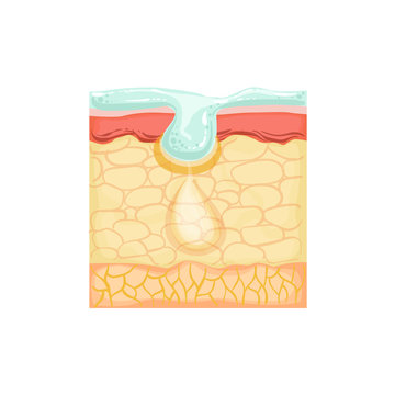 Dermatology Skincare Anatomical Info Illustration Demonstrating Skin Problem Treatment With Cosmetology Cleansing Product