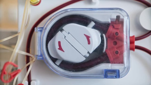 Hemodialysis machines with tubing and installations. Health care, blood purification, kidney failure, transplantation, medical equipment concept. Close up