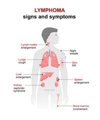 lymphoma. Signs and symptoms - obrazy, fototapety, plakaty