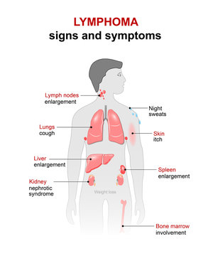 lymphoma. Signs and symptoms