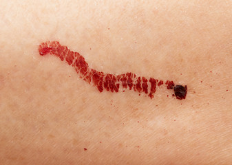 a drop of blood on the skin