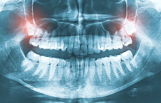 Closeup of x-ray image growing wisdom teeth pain concept.