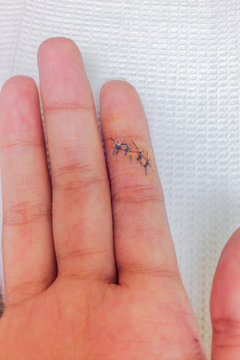 after index finger on right hand is cut, wound and stitches fing