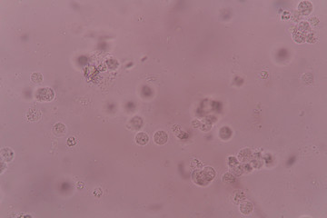 white blood cell clumping in urine