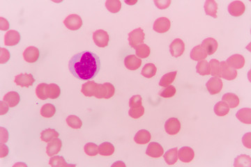 Lymphocyte  human blood cell under microscope,complete blood count.