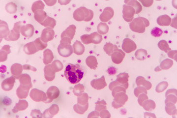 in Slide blood smear show giant platelet under microscope