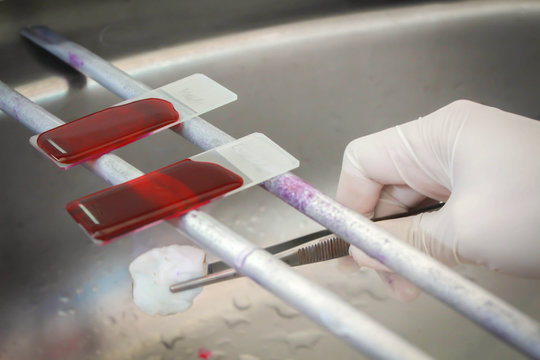Modify Kinyoun AFB Stain