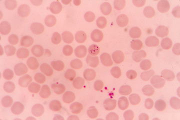 plasmodium falciparum ring form state , multiple in fection of red blood cells