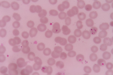 Fototapeta na wymiar plasmodium falciparum infections red blood cells