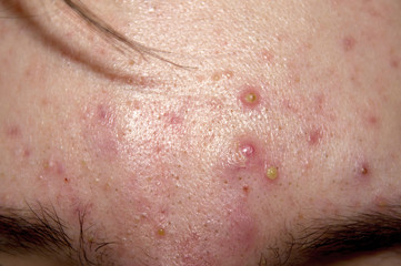 pimples on a teenager 's forehead